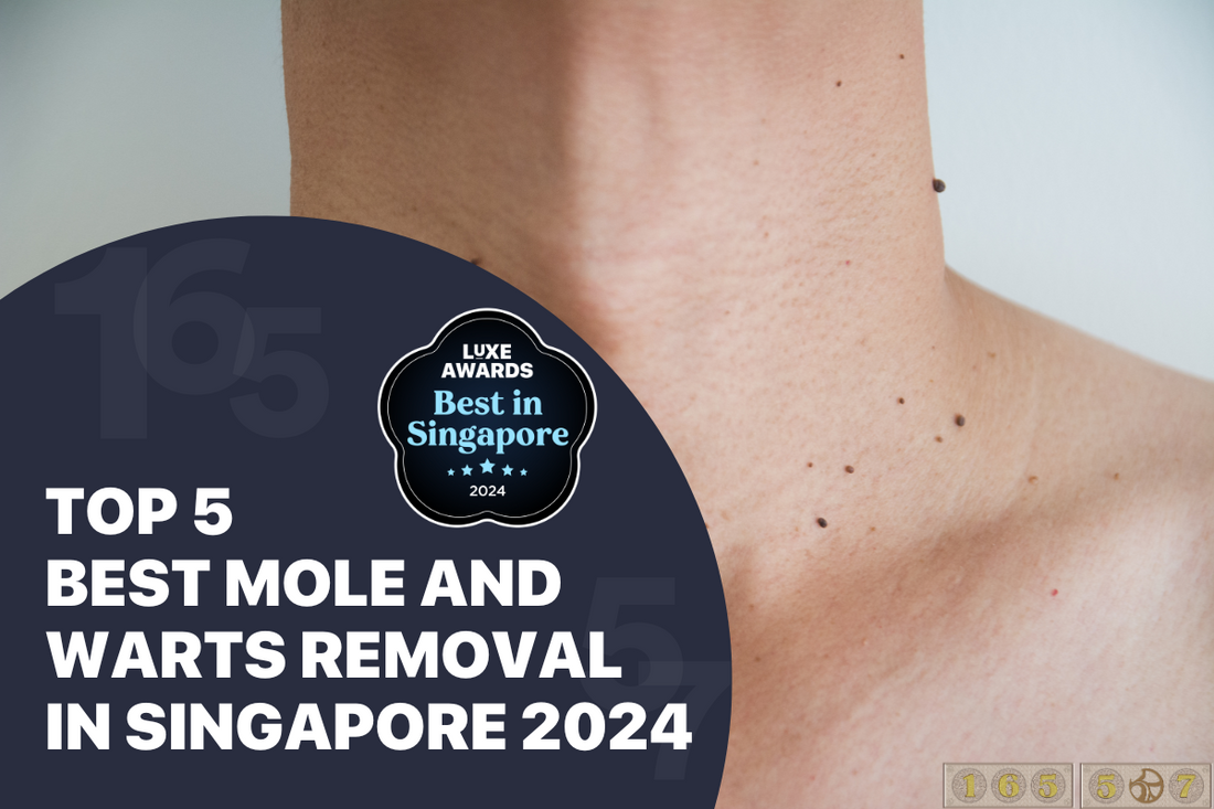 Top 5 Best Mole and Warts Removal in Singapore 2024